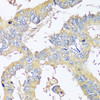 Immunohistochemistry of paraffin-embedded Human colon carcinoma using BLOC1S3 Polyclonal Antibody at dilution of  1:100 (40x lens).