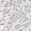 Immunohistochemistry of paraffin-embedded Human breast cancer using BLOC1S3 Polyclonal Antibody at dilution of  1:100 (40x lens).