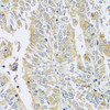 Immunohistochemistry of paraffin-embedded Human uterine cancer using BLOC1S3 Polyclonal Antibody at dilution of  1:100 (40x lens).