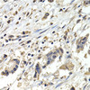 Immunohistochemistry of paraffin-embedded Human breast cancer using BUB1B Polyclonal Antibody at dilution of  1:200 (40x lens).