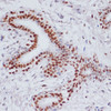 Immunohistochemistry of paraffin-embedded Human breast cancer using Acetyl-Histone H3-K9/K14/K18/K23/K27 Polyclonal Antibody at dilution of  1:100 (40x lens).