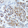 Immunohistochemistry of paraffin-embedded Human liver cancer using PDE3A Polyclonal Antibody at dilution of  1:100 (40x lens).