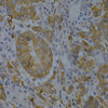 Immunohistochemistry of paraffin-embedded Human gastric cancer using BIN1 Polyclonal Antibody at dilution of  1:200 (40x lens).