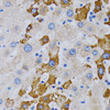 Immunohistochemistry of paraffin-embedded Human liver cancer using CYP24A1 Polyclonal Antibody at dilution of  1:200 (40x lens).