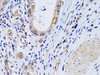 Immunohistochemistry of paraffin-embedded Human gastric cancer using PTGIR Polyclonal Antibody at dilution of  1:200 (40x lens).