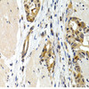 Immunohistochemistry of paraffin-embedded Human stomach cancer using IL9 Polyclonal Antibody at dilution of  1:200 (40x lens).