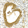 Immunohistochemistry of paraffin-embedded Human adenomyosis using RAB27A Polyclonal Antibody at dilution of  1:200 (40x lens).