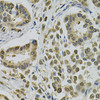 Immunohistochemistry of paraffin-embedded Human breast cancer using EBAG9 Polyclonal Antibody at dilution of  1:100 (40x lens).