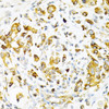 Immunohistochemistry of paraffin-embedded Human gastric cancer using TAPBP Polyclonal Antibody at dilution of  1:200 (40x lens).