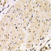 Immunohistochemistry of paraffin-embedded Human stomach cancer using TMPRSS2 Polyclonal Antibody at dilution of  1:200 (40x lens).