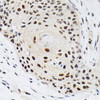 Immunohistochemistry of paraffin-embedded Human esophageal cancer using KPNA4 Polyclonal Antibody at dilution of  1:200 (40x lens).