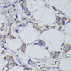 Immunohistochemistry of paraffin-embedded Human mammary cancer using GSK3B Polyclonal Antibody at dilution of  1:200 (40x lens).