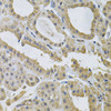 Immunohistochemistry of paraffin-embedded Human thyroid cancer using NCF4 Polyclonal Antibody at dilution of  1:100 (40x lens).