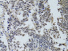Immunohistochemistry of paraffin-embedded Human lung cancer using LKB1 Polyclonal Antibody at dilution of  1:100 (40x lens).