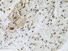 Immunohistochemistry of paraffin-embedded Human colon carcinoma using LKB1 Polyclonal Antibody at dilution of  1:100 (40x lens).