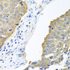 Immunohistochemistry of paraffin-embedded Human lung cancer using EIF4E Polyclonal Antibody at dilution of  1:100 (40x lens).