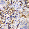 Immunohistochemistry of paraffin-embedded Human liver cancer using HCLS1 Polyclonal Antibody at dilution of  1:100 (40x lens).