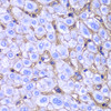 Immunohistochemistry of paraffin-embedded Human liver damage using HLA-A Polyclonal Antibody at dilution of  1:100 (40x lens).
