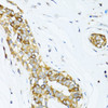 Immunohistochemistry of paraffin-embedded Human breast cancer using DCTN2 Polyclonal Antibody at dilution of  1:100 (40x lens).