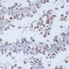 Immunohistochemistry of paraffin-embedded Human lung cancer using DNMT3L Polyclonal Antibody at dilution of  1:100 (40x lens).