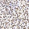Immunohistochemistry of paraffin-embedded Human kidney cancer using DiMethyl-Histone H3-K4 Polyclonal Antibody at dilution of  1:200 (40x lens).