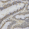Immunohistochemistry of paraffin-embedded Human rectal cancer using TriMethyl-Histone H3-K4 Polyclonal Antibody at dilution of  1:200 (40x lens).