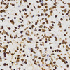 Immunohistochemistry of paraffin-embedded Human kidney cancer using DiMethyl-Histone H3-K27 Polyclonal Antibody at dilution of  1:200 (40x lens).