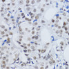 Immunohistochemistry of paraffin-embedded Human mammary cancer using DiMethyl-Histone H3-K79 Polyclonal Antibody at dilution of  1:200 (40x lens).