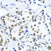 Immunohistochemistry of paraffin-embedded Human mammary cancer using TriMethyl-Histone H3-K79 Polyclonal Antibody at dilution of  1:200 (40x lens).