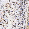 Immunohistochemistry of paraffin-embedded Human rectal cancer using Asymmetric DiMethyl-Histone H4-R3 Polyclonal Antibody at dilution of  1:200 (40x lens).