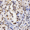 Immunohistochemistry of paraffin-embedded Human lung cancer using Asymmetric DiMethyl-Histone H3-R17 Polyclonal Antibody at dilution of  1:200 (40x lens).