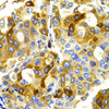 Immunohistochemistry of paraffin-embedded Human liver cancer using CDK20 Polyclonal Antibody at dilution of  1:100 (40x lens).