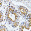 Immunohistochemistry of paraffin-embedded Human colon carcinoma using TRAP1 Polyclonal Antibody at dilution of  1:100 (40x lens).