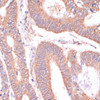 Immunohistochemistry of paraffin-embedded Human colon carcinoma using KCNH2 Polyclonal Antibody at dilution of  1:100 (40x lens).