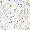 Immunohistochemistry of paraffin-embedded Human kidney cancer using SUMO4 Polyclonal Antibody at dilution of  1:100 (40x lens).