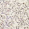 Immunohistochemistry of paraffin-embedded Human lung cancer using NELFE Polyclonal Antibody at dilution of  1:100 (40x lens).