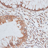 Immunohistochemistry of paraffin-embedded Human colon carcinoma using KIFC1 Polyclonal Antibody at dilution of  1:100 (40x lens).