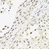 Immunohistochemistry of paraffin-embedded Human lung cancer using C14orf166 Polyclonal Antibody at dilution of  1:100 (40x lens).