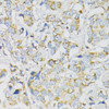 Immunohistochemistry of paraffin-embedded Human breast cancer using ATP5J Polyclonal Antibody at dilution of  1:100 (40x lens).