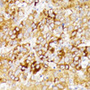 Immunohistochemistry of paraffin-embedded Human liver cancer using GALC Polyclonal Antibody at dilution of  1:100 (40x lens).