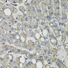 Immunohistochemistry of paraffin-embedded Human liver damage using GFPT1 Polyclonal Antibody at dilution of  1:100 (40x lens).