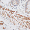 Immunohistochemistry of paraffin-embedded Human colon carcinoma using GRK5 Polyclonal Antibody at dilution of  1:100 (40x lens).