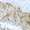 Immunohistochemistry of paraffin-embedded Human lung cancer using IFIT3 Polyclonal Antibody at dilution of  1:100 (40x lens).