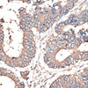 Immunohistochemistry of paraffin-embedded Human colon carcinoma using KRT81 Polyclonal Antibody at dilution of  1:100 (40x lens).