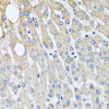 Immunohistochemistry of paraffin-embedded Human liver damage using UQCRC2 Polyclonal Antibody at dilution of  1:100 (40x lens).