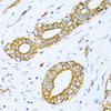 Immunohistochemistry of paraffin-embedded Human breast cancer using VARS Polyclonal Antibody at dilution of  1:100 (40x lens).