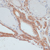 Immunohistochemistry of paraffin-embedded Human thyroid cancer using MYCBP Polyclonal Antibody at dilution of  1:100 (40x lens).