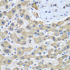 Immunohistochemistry of paraffin-embedded Human liver cancer using GFM1 Polyclonal Antibody at dilution of  1:100 (40x lens).