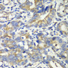 Immunohistochemistry of paraffin-embedded Human gastric cancer using ABAT Polyclonal Antibody at dilution of  1:100 (40x lens).