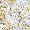 Immunohistochemistry of paraffin-embedded Human kidney cancer using GLRX Polyclonal Antibody at dilution of  1:200 (40x lens).